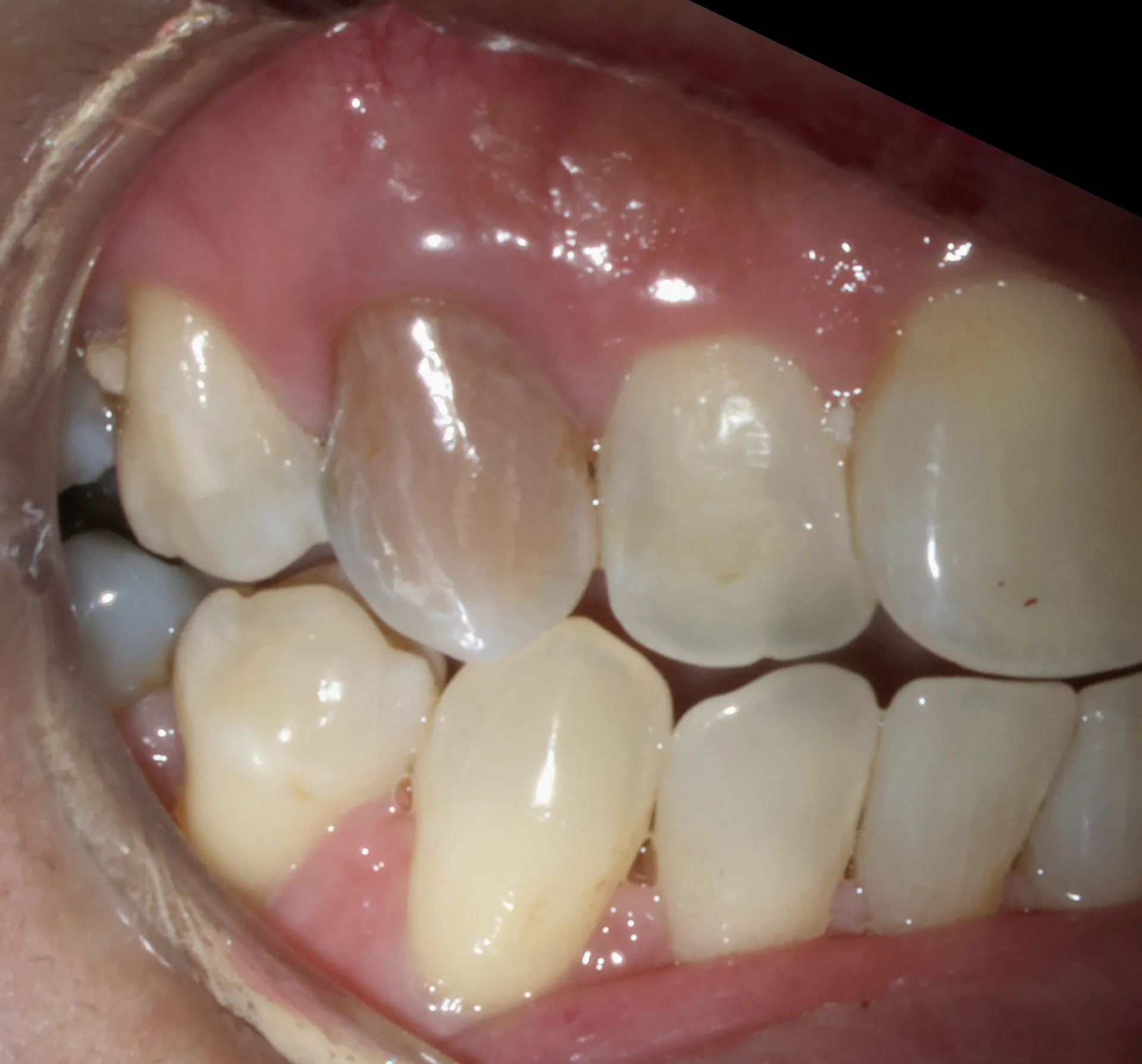Clinical photo showing gray discoloration of maxillary incisor before internal bleaching treatment - adult female patient, buccal view